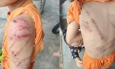 Lý do người cha đánh con 10 tuổi bầm tím khắp người