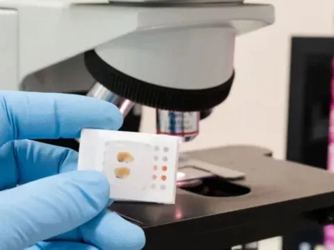 Thêm tiềm năng của AI trong cải thiện điều trị ung thư