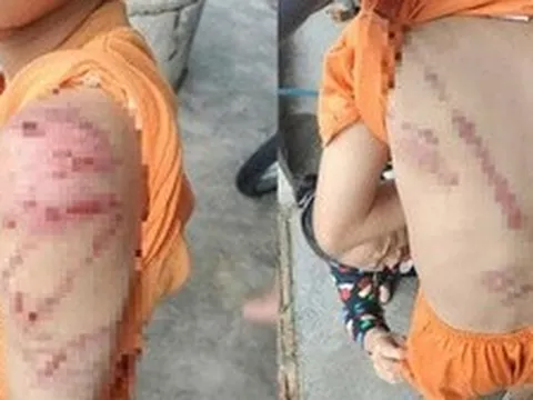 Lý do người cha đánh con 10 tuổi bầm tím khắp người